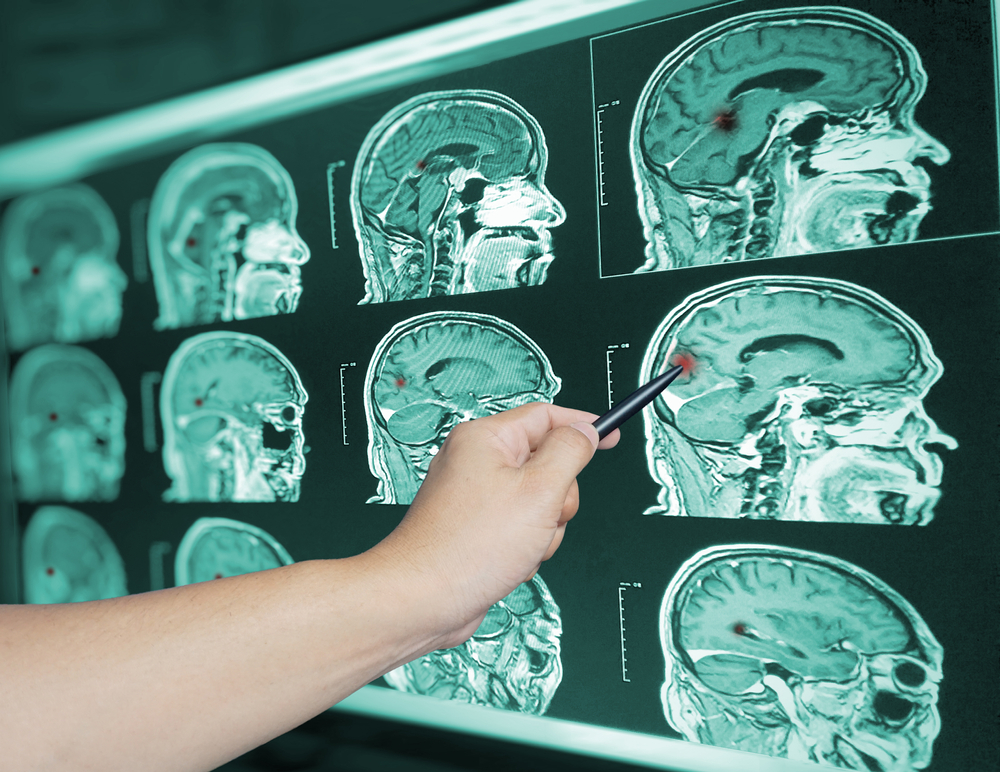 Doctor analyzing MRI brain scans that show signs of traumatic brain injury, representing the medical evidence used in Houston brain injury claims.